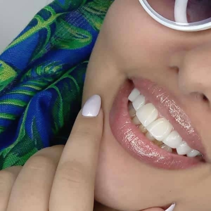 کامپوزیت زیبای دندان